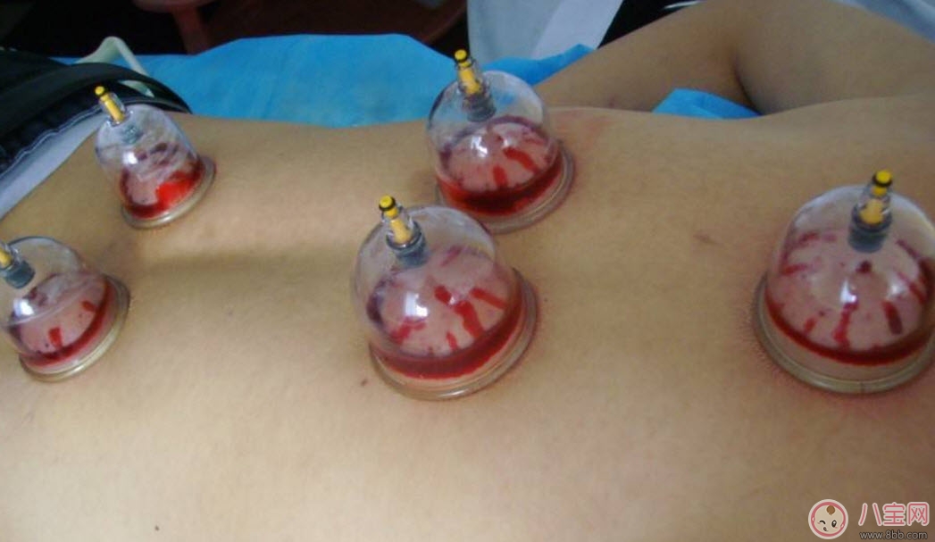 孕婦拔火罐可以嗎 孕婦肩膀能拔火罐嗎(孕婦拔過火罐怎么辦) 孕婦拔火罐可以嗎 孕婦肩膀能拔火罐嗎(孕婦拔過火罐怎么辦)