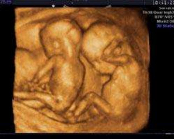 孕婦懷雙胞胎吃什么好 孕婦懷雙胞胎的癥狀有哪些