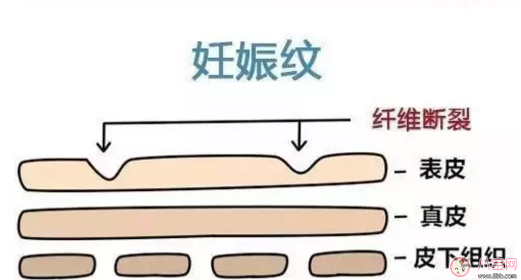 擺脫妊娠紋 哪些方法容易又簡單 擺脫妊娠紋 哪些方法容易又簡單