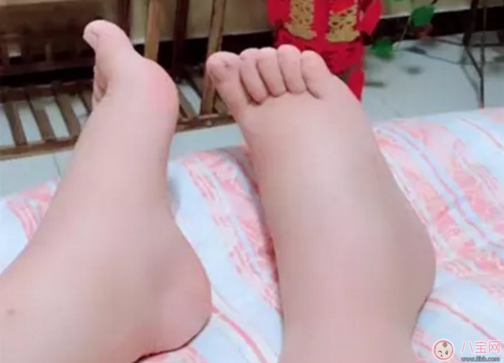 孕晚期水腫怎么緩解 孕婦孕晚期浮腫是什么原因 孕晚期水腫怎么緩解 孕婦孕晚期浮腫是什么原因