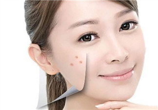 孕婦孕期長痘痘怎么辦 孕期痘痘怎么調(diào)理(長痘痘吃什么)