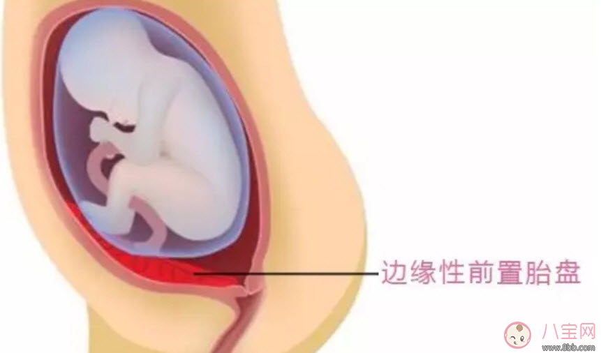 孕婦胎盤低怎么辦 孕婦胎盤低是什么原因造成的(胎盤低要注意什么) 孕婦胎盤低怎么辦 孕婦胎盤低是什么原因造成的(胎盤低要注意什么)