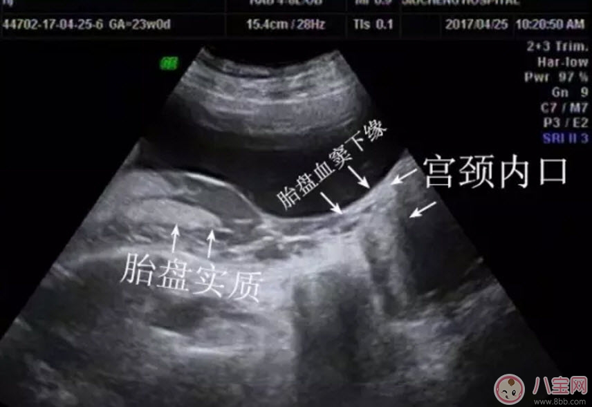 孕婦胎盤低怎么辦 孕婦胎盤低是什么原因造成的(胎盤低要注意什么) 孕婦胎盤低怎么辦 孕婦胎盤低是什么原因造成的(胎盤低要注意什么)