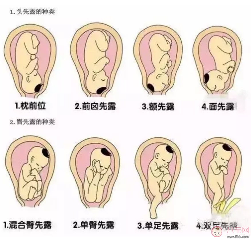 孕晚期胎位不正怎么辦 孕晚期胎位圖 孕晚期胎位不正怎么辦 孕晚期胎位圖