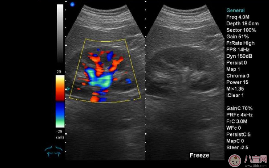 b超和彩超的區(qū)別 什么情況下使用普通B超或彩超