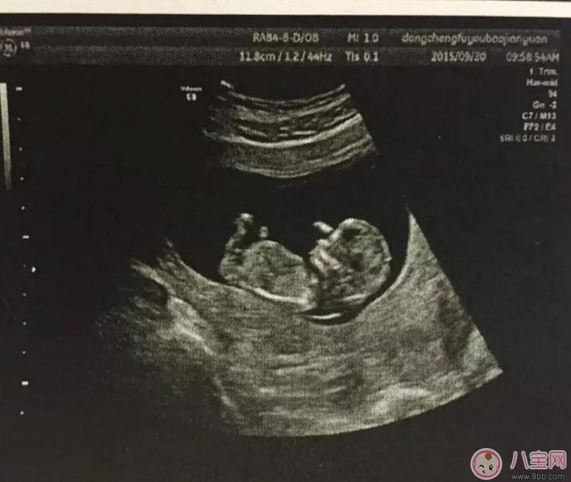 b超和彩超的區(qū)別 什么情況下使用普通B超或彩超