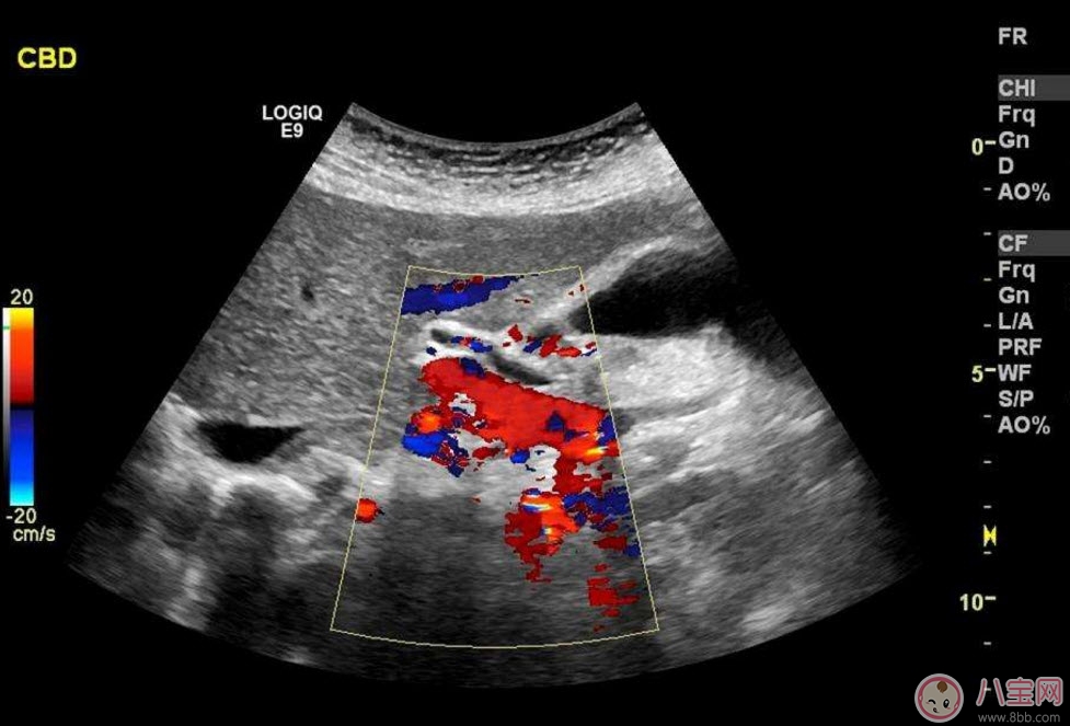 b超和彩超的區(qū)別 什么情況下使用普通B超或彩超