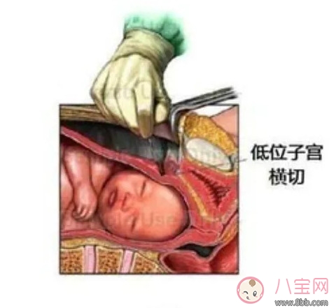剖腹產(chǎn)孕婦會不會感到疼痛 剖腹產(chǎn)橫剖還是縱剖。