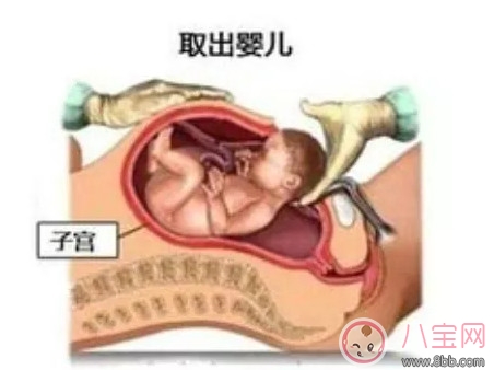 剖腹產(chǎn)孕婦會不會感到疼痛 剖腹產(chǎn)橫剖還是縱剖。
