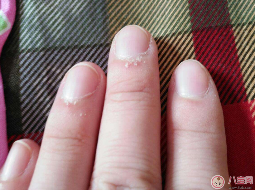 手上長(zhǎng)這個(gè)千萬(wàn)不要撕 倒刺的正確處理方法