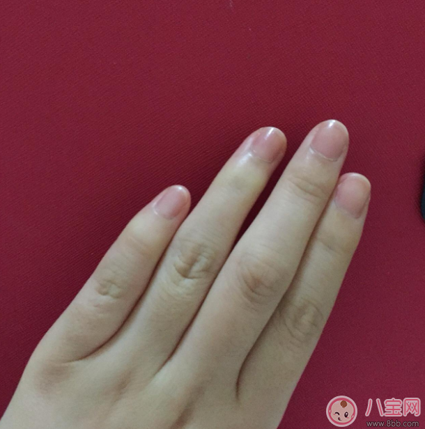 手上長(zhǎng)這個(gè)千萬(wàn)不要撕 倒刺的正確處理方法