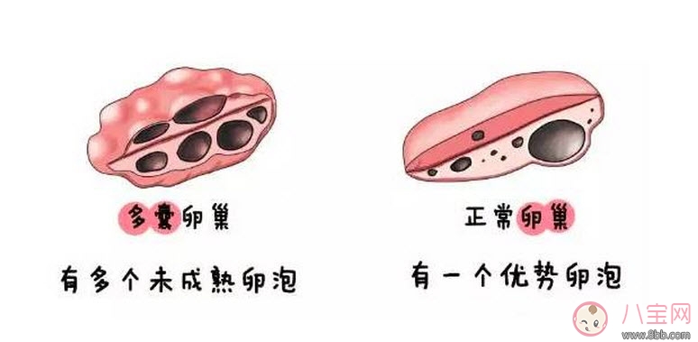 昆凌三胎計(jì)劃，昆凌多囊性卵巢癥候群是什么病