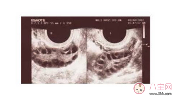 昆凌三胎計(jì)劃，昆凌多囊性卵巢癥候群是什么病