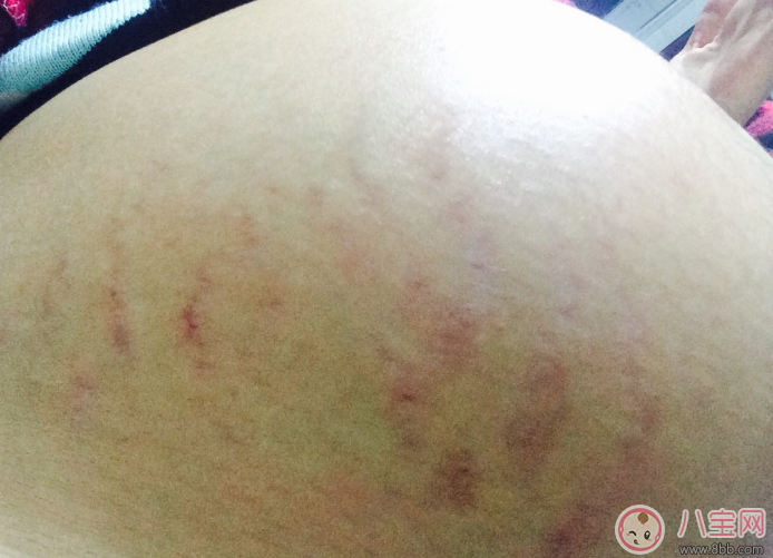 孕辰紋怎么消除 這些產(chǎn)品防止孕辰紋產(chǎn)生和消除孕辰紋