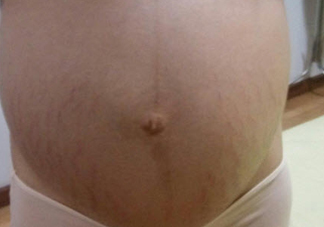 孕辰紋怎么消除 這些產(chǎn)品防止孕辰紋產(chǎn)生和消除孕辰紋