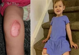 這樣居然也能燙傷 三伏天戶外兒童玩具少讓孩子玩