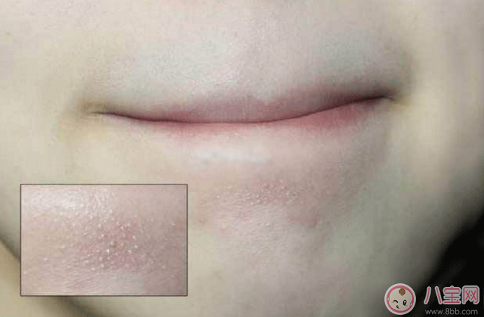 抿嘴時下巴上面的白色小顆粒是不是粉刺