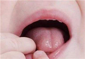 寶寶口腔潰瘍原因有哪些 寶寶口腔潰瘍怎么辦吃什么好的快