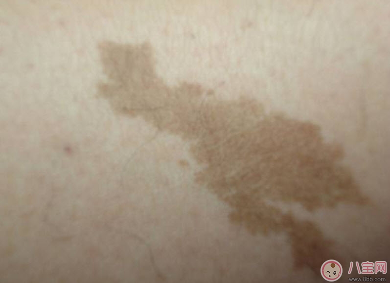 嬰兒屁股下面有胎記有什么含義 新生兒寶寶屁股下面有胎記好不好