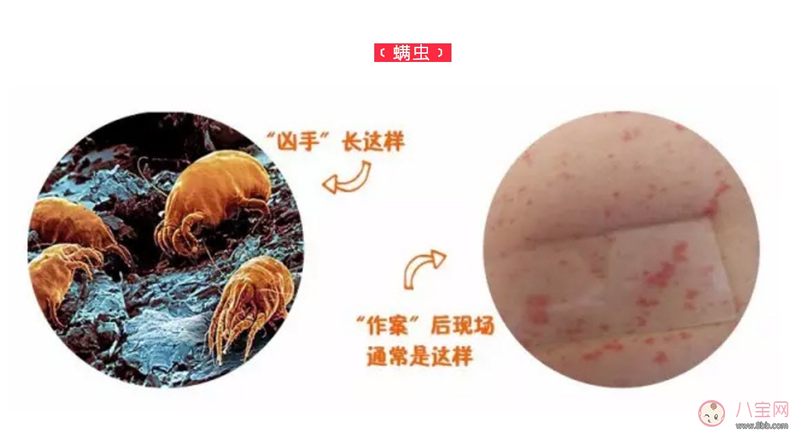 寶寶螨蟲過敏怎么辦，寶寶被螨蟲咬和蚊子咬癥狀對比圖片區(qū)別