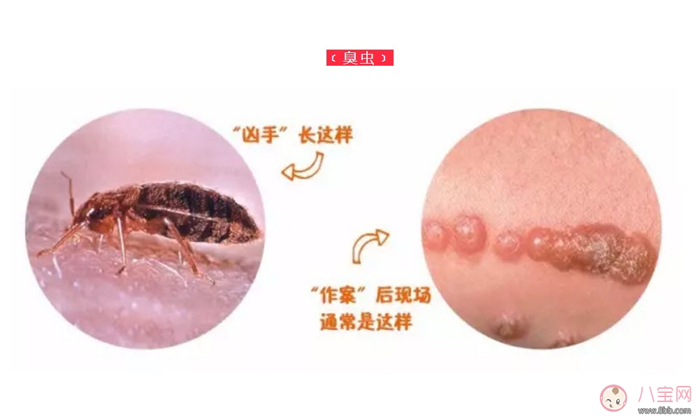 寶寶被臭蟲咬了癥狀圖片 寶寶被臭蟲咬和蚊子咬癥狀對比圖片區(qū)別 寶寶被臭蟲咬了癥狀圖片 寶寶被臭蟲咬和蚊子咬癥狀對比圖片區(qū)別