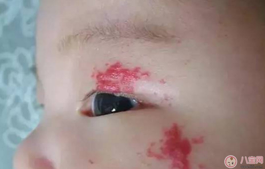 寶寶胎記多大治療最好 寶寶治療胎記的最佳時(shí)間