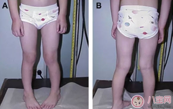 寶寶走路內八字怎么辦 寶寶走路內八字的原因有哪些 寶寶走路內八字怎么辦 寶寶走路內八字的原因有哪些