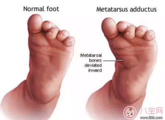 寶寶走路內八字怎么辦 寶寶走路內八字的原因有哪些 寶寶走路內八字怎么辦 寶寶走路內八字的原因有哪些