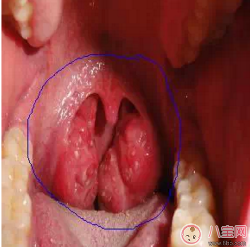 寶寶扁桃體炎表現(xiàn) 如何預防小兒扁桃體炎