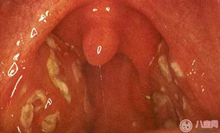 寶寶扁桃體炎表現(xiàn) 如何預防小兒扁桃體炎