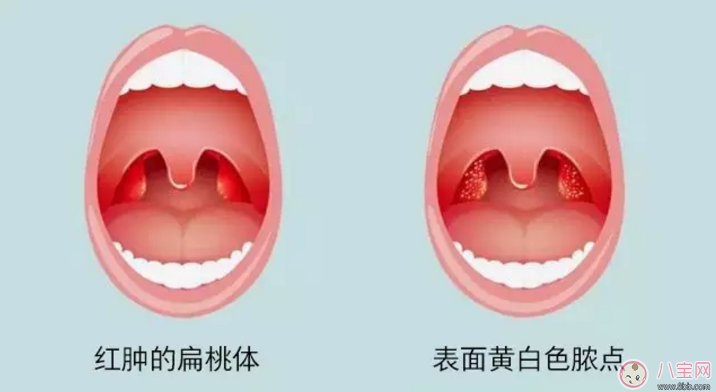 寶寶扁桃體炎表現(xiàn) 如何預防小兒扁桃體炎
