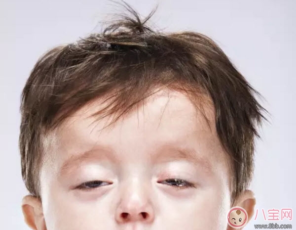 嬰兒鬼臉綜合癥癥狀圖有哪些 過(guò)量補(bǔ)鈣造成鬼臉綜合癥的危害是什么 嬰兒鬼臉綜合癥癥狀圖有哪些 過(guò)量補(bǔ)鈣造成鬼臉綜合癥的危害是什么