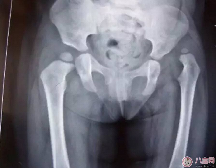 寶寶臀紋不對稱怎么回事 臀紋不對稱一定是髖關(guān)節(jié)發(fā)育不良嗎 寶寶臀紋不對稱怎么回事 臀紋不對稱一定是髖關(guān)節(jié)發(fā)育不良嗎