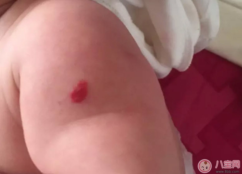 新生兒紅色胎記和血管瘤的對比方法 寶寶胎記和血管瘤的區(qū)別