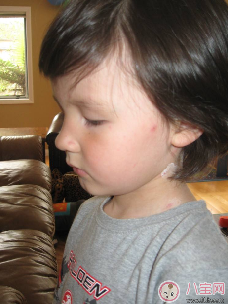 孩子長水痘這些東西千萬遠離 孩子水痘好得快方法