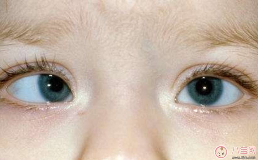 寶寶斜視手術(shù)風(fēng)險大嗎 寶寶斜視一定要做手術(shù)嗎 寶寶斜視手術(shù)風(fēng)險大嗎 寶寶斜視一定要做手術(shù)嗎