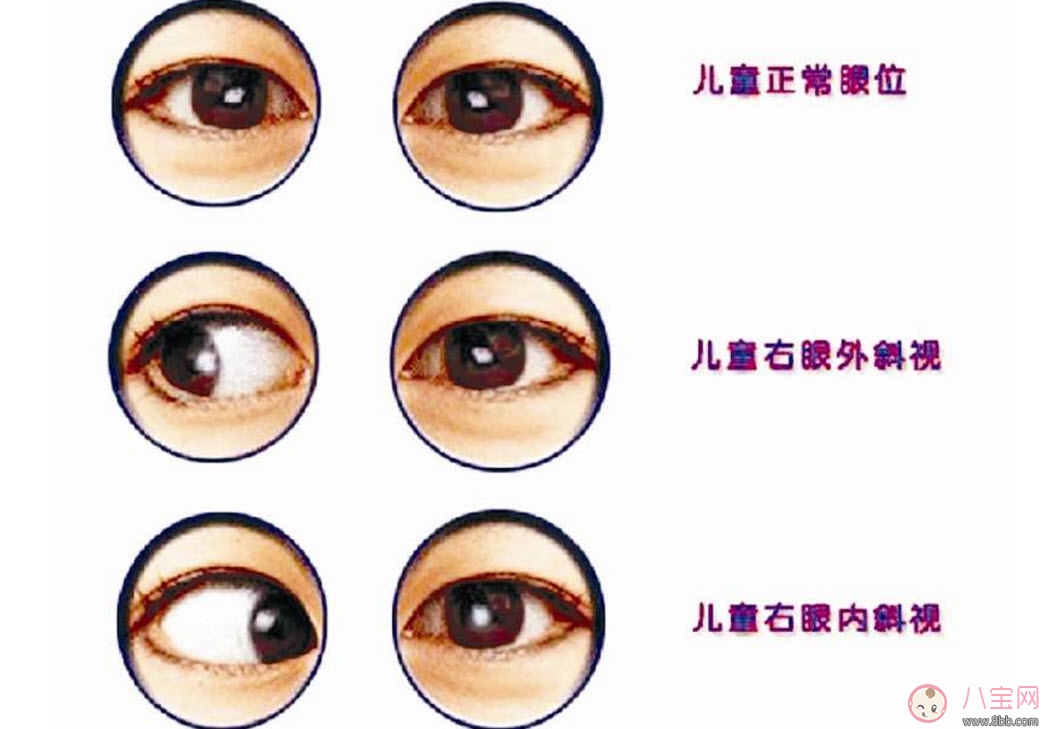 寶寶斜視手術(shù)風(fēng)險大嗎 寶寶斜視一定要做手術(shù)嗎 寶寶斜視手術(shù)風(fēng)險大嗎 寶寶斜視一定要做手術(shù)嗎