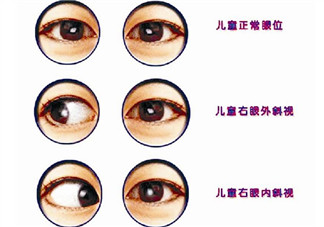 寶寶斜視手術風險大嗎 寶寶斜視一定要做手術嗎