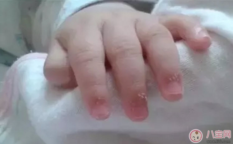 寶寶手上長肉刺是因?yàn)槿狈I養(yǎng)嗎 寶寶手指上長倒刺是什么原因 寶寶手上長肉刺是因?yàn)槿狈I養(yǎng)嗎 寶寶手指上長倒刺是什么原因