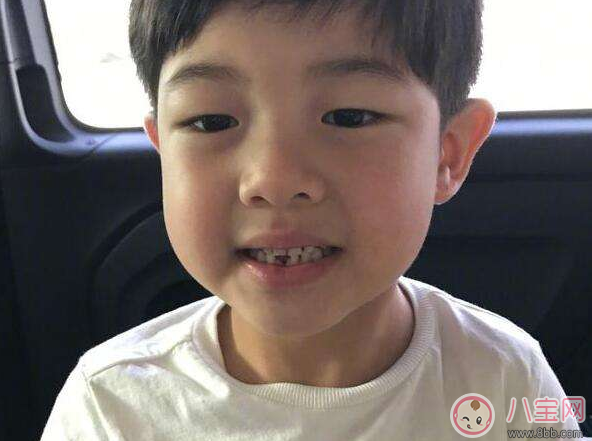 孩子換牙牙不掉 孩子雙排牙要不要拔