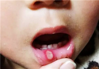 寶寶口腔潰瘍怎么辦 寶寶口腔潰瘍吃什么好的快