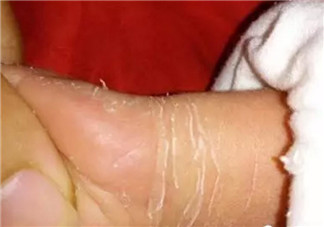 新生兒手腳脫皮要多久 新生兒脫皮怎么護(hù)理(能搽點(diǎn)什么)