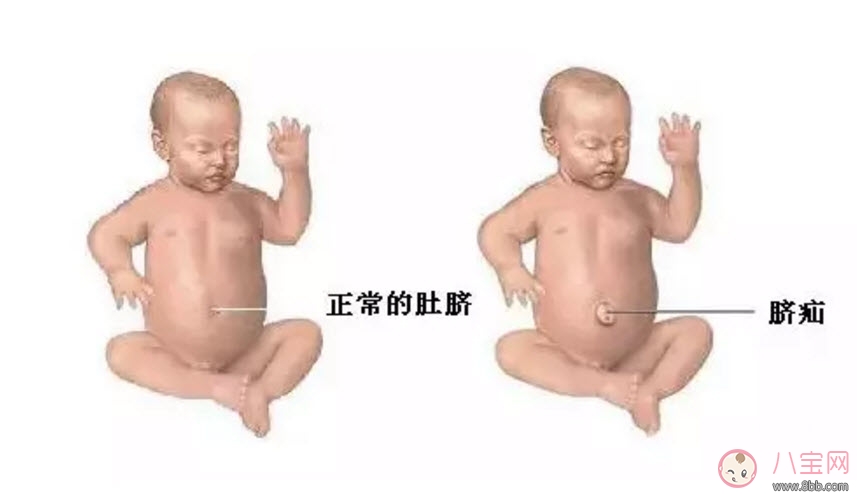 臍疝對(duì)寶寶有什么影響 寶寶臍疝是什么原因引起的 臍疝對(duì)寶寶有什么影響 寶寶臍疝是什么原因引起的