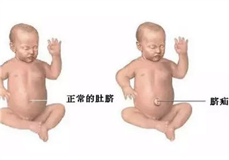 臍疝對寶寶有什么影響 寶寶臍疝是什么原因引起的