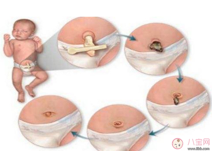 新生兒臍帶消毒用什么 臍帶消毒用碘伏好還是酒精(肚臍消毒圖解) 新生兒臍帶消毒用什么 臍帶消毒用碘伏好還是酒精(肚臍消毒圖解)
