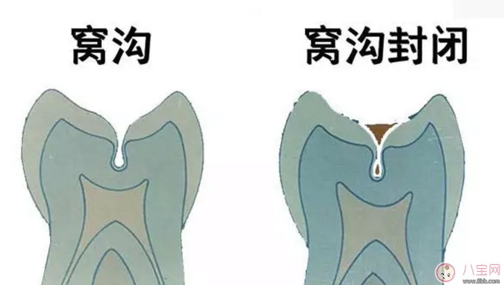 寶寶幾歲做窩溝封閉 兒童做窩溝封閉好不好 寶寶幾歲做窩溝封閉 兒童做窩溝封閉好不好
