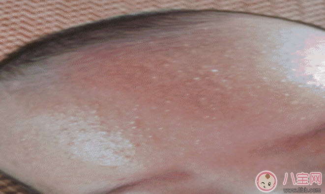 寶寶痱子和濕疹的區(qū)別 寶寶濕疹和痱子最大的不同是什么 寶寶痱子和濕疹的區(qū)別 寶寶濕疹和痱子最大的不同是什么