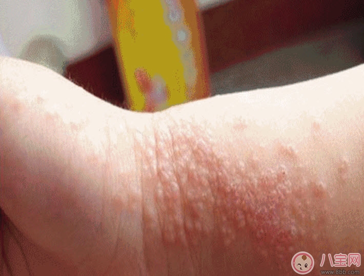 寶寶痱子和濕疹的區(qū)別 寶寶濕疹和痱子最大的不同是什么 寶寶痱子和濕疹的區(qū)別 寶寶濕疹和痱子最大的不同是什么