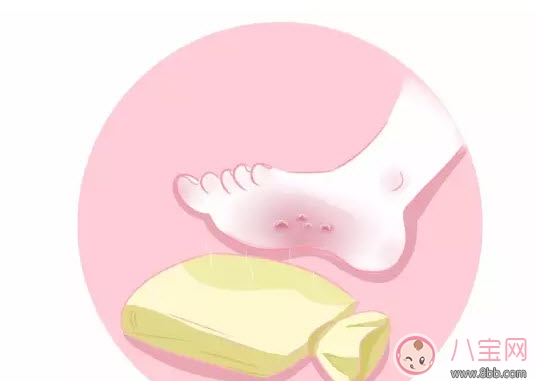 寶寶燙傷怎么辦 寶寶燙傷急救處理方法 寶寶燙傷怎么辦 寶寶燙傷急救處理方法