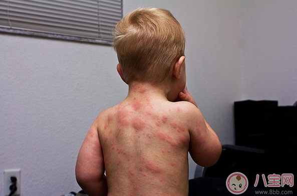 孩子玫瑰疹怎么護理 細心護理好得快